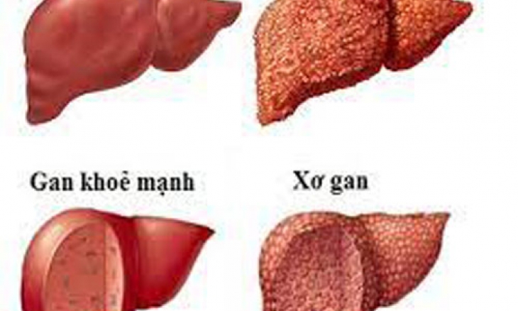 Thuốc lá gây nhiều bệnh nguy hiểm cho Gan