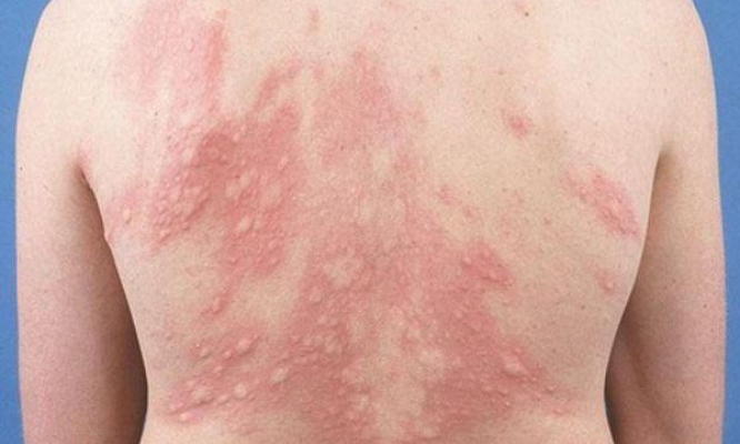 Dị ứng thức ăn ngày Tết: Nhận biết và cách xử trí