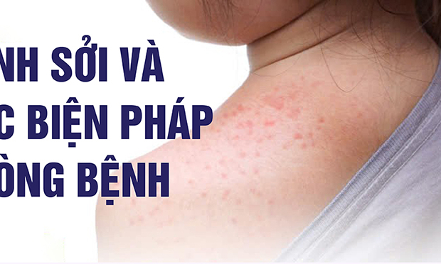 Bệnh sởi và các biện pháp phòng bệnh