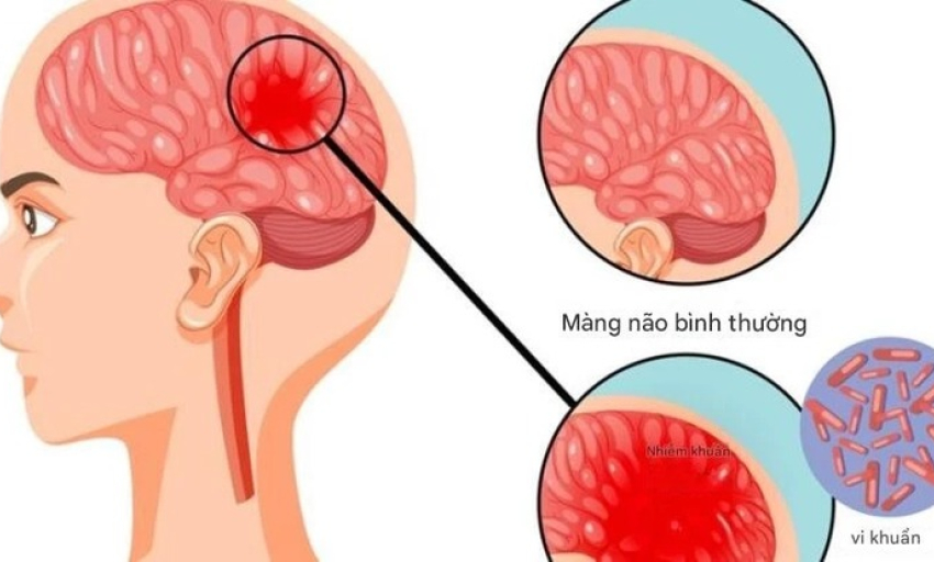 Bệnh n&atilde;o m&ocirc; cầu c&oacute; thể g&acirc;y tử vong nhanh, chuy&ecirc;n gia cảnh b&aacute;o những dấu hiệu nguy hiểm