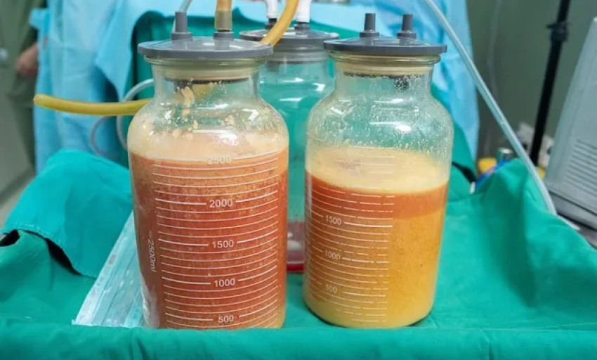 H&uacute;t ra gần 5 l&iacute;t 'chất lạ' tồn tại 20 năm trong ngực người phụ nữ