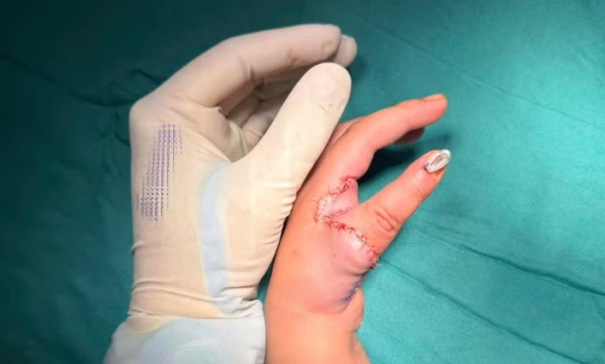 T&aacute;i tạo ng&oacute;n c&aacute;i cho trẻ bằng ch&iacute;nh ng&oacute;n trỏ, mở ra cơ hội mới cho trẻ mắc dị tật bẩm sinh