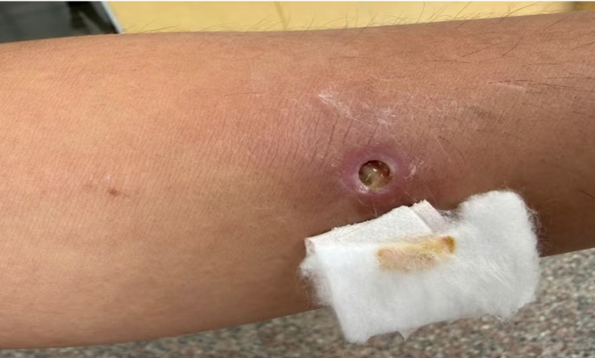 Th&ecirc;m một ca giun rồng được ph&aacute;t hiện tại Việt Nam