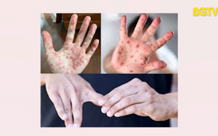 An to&agrave;n sống: Kh&ocirc;ng chủ quan với bệnh thuỷ đậu