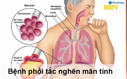 An to&agrave;n sống: Ph&ograve;ng v&agrave; chữa bệnh vi&ecirc;m phổi