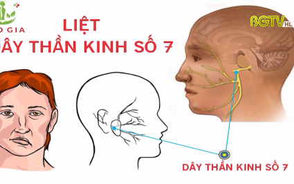 Bệnh liệt d&acirc;y thần kinh số 7 ngoại bi&ecirc;n