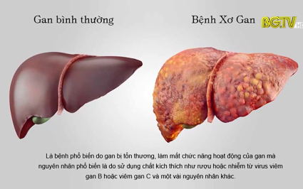 Bệnh xơ gan - Nguy&ecirc;n nh&acirc;n, triệu chứng v&agrave; c&aacute;ch ph&ograve;ng tr&aacute;nh