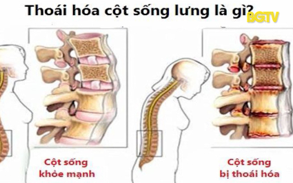 Những điều cần biết về bệnh tho&aacute;i h&oacute;a cột sống thắt lưng 