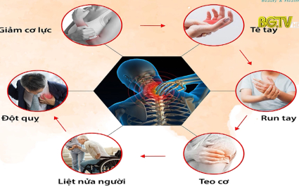 Ph&ograve;ng ngừa bệnh đau cổ vai g&aacute;y